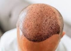 Breast Reduction Vs Breast Lift: Key Differences Explained